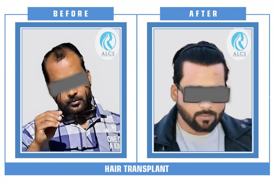 Slider image (6) ALCS - Hair Transplant &  Cosmetic Clinic